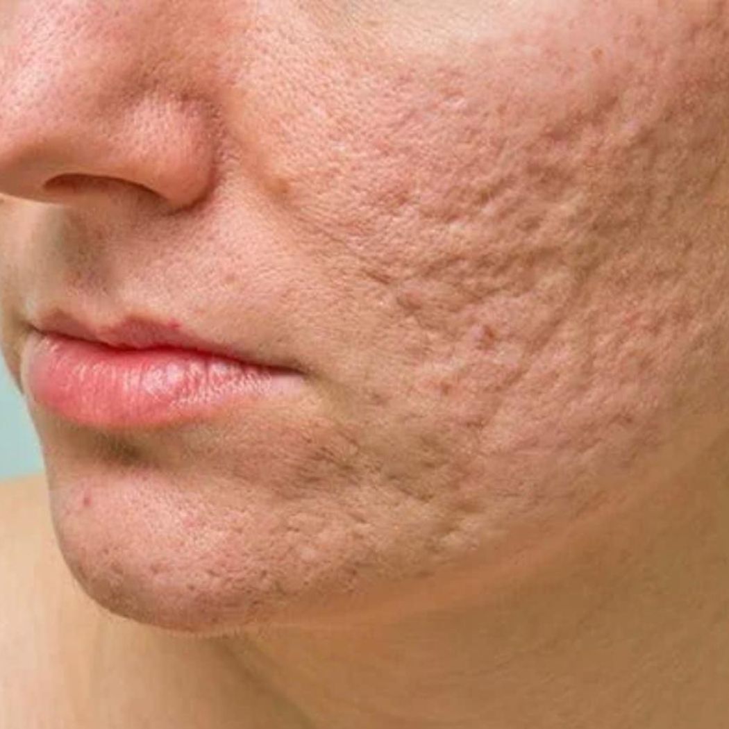 Problemhaut Behandlung - Pure Skin by Jean-Pascal Rheine