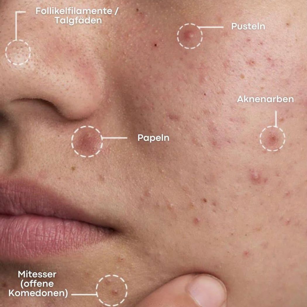 Problemhaut Behandlung - Pure Skin by Jean-Pascal Rheine